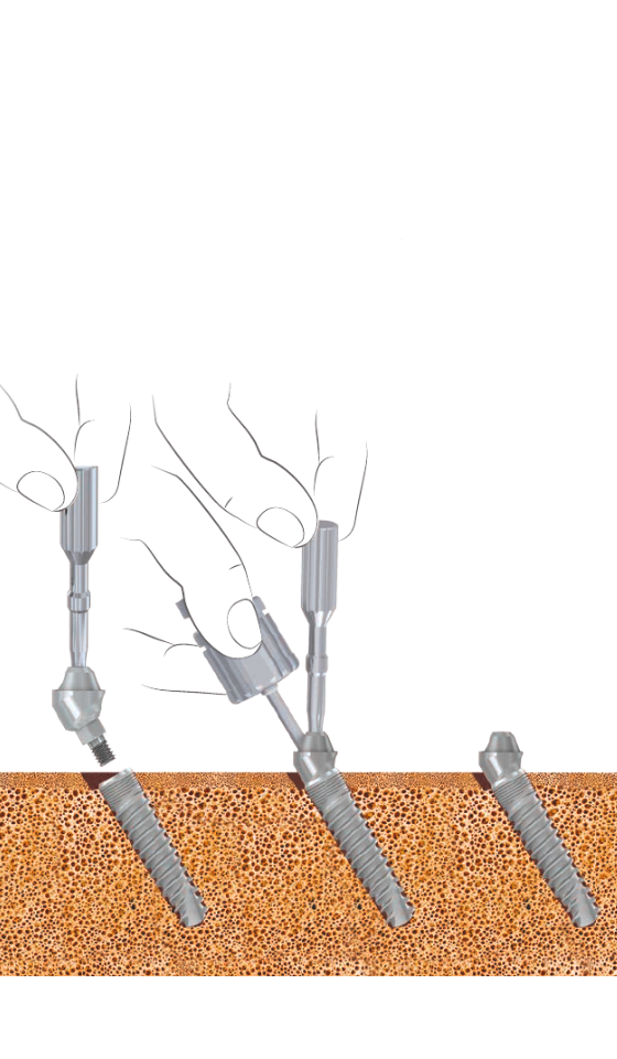 Протезирование зубов All in 4 all in 4 протезирование